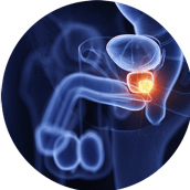 Urólogo – Cáncer-próstata Urólogo - Cáncer-próstata