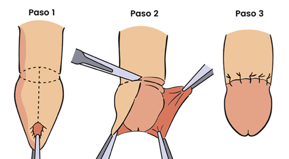 Urólogo - circuncisión