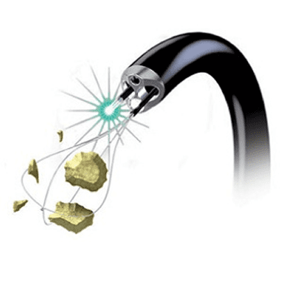 Urólogo - cirugía-láser