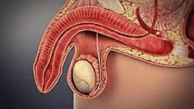 Urólogo - disfunción-eréctil