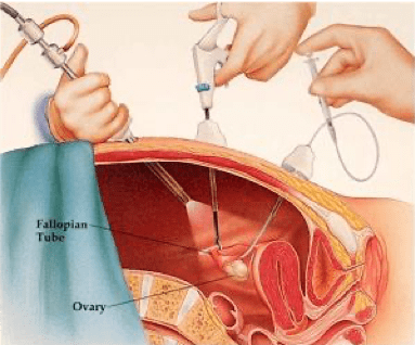 Urólogo - laparoscopia