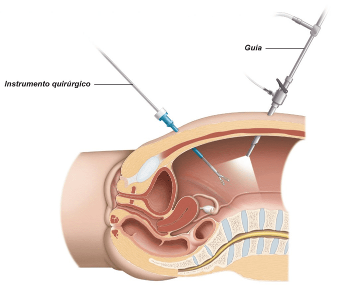 Urólogo - nefrectomía