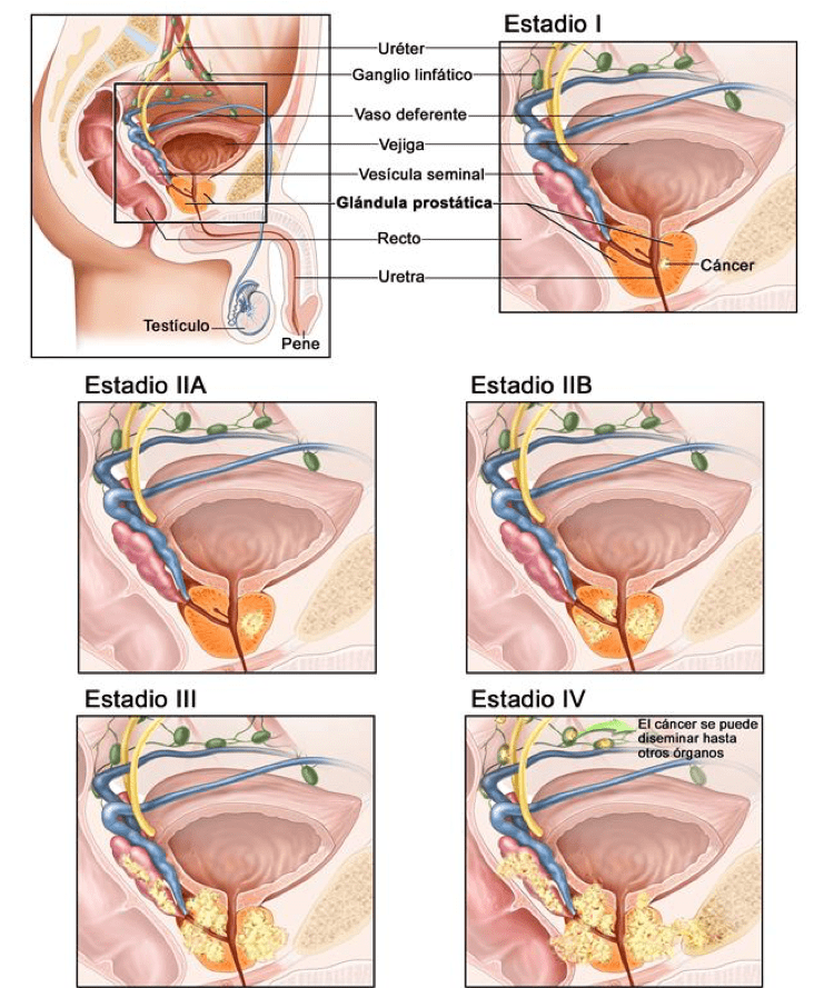 Urólogo - cáncer-próstata