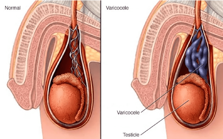 Urólogo - varicocele