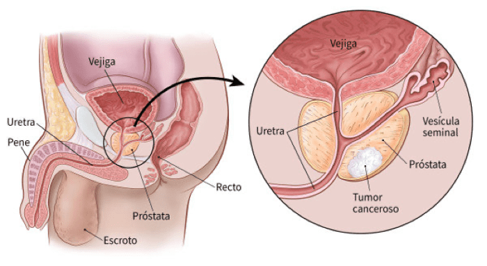 Urólogo - Cáncer-próstata