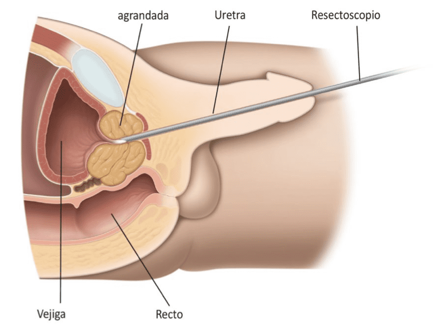 Urólogo - litotricia